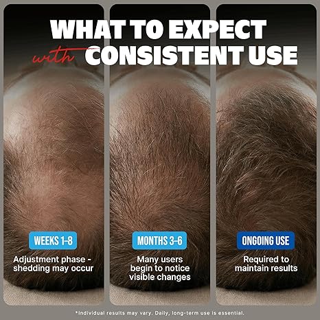 Kirkland Minoxidil 5% Extra Strength – 6 Month Hair Regrowth Supply for Men