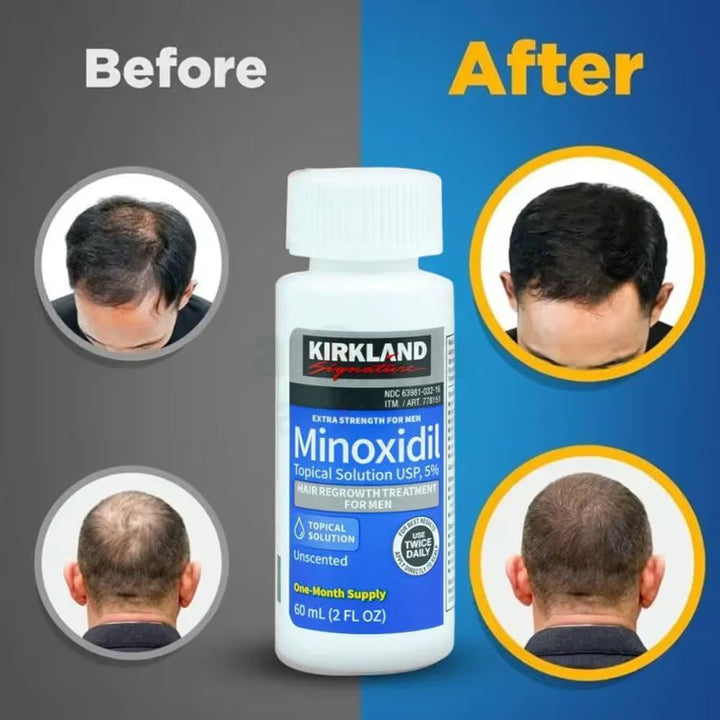 Kirkland Minoxidil 5% Hair Regrowth Treatment – 6 Month Supply 💧🔥